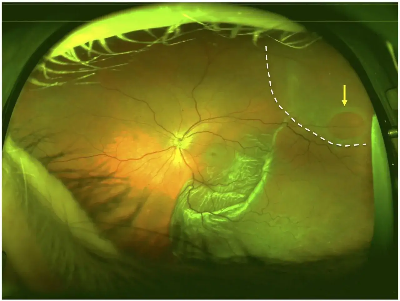 Esame del fondo oculare che mostra una schisi retinica, evidenziata da una linea tratteggiata e una freccia gialla. La cura per la schisi retinica è fondamentale.