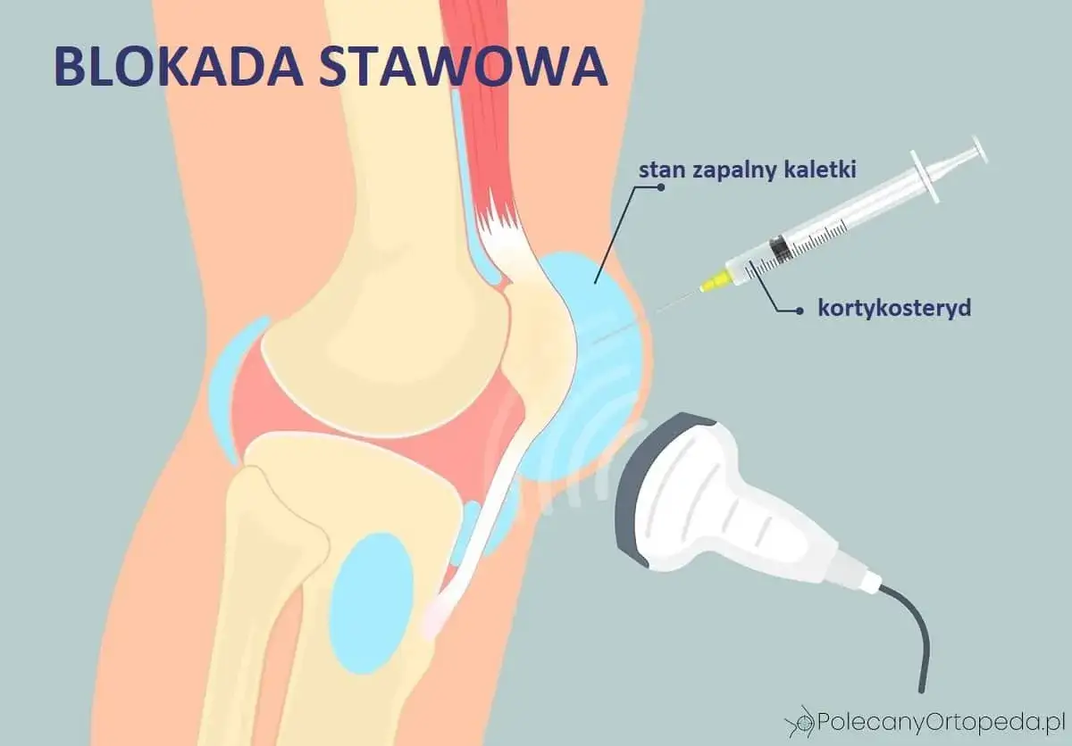 Blokada stawowa: zastrzyk kortykosterydu, np. Diprophos, w stan zapalny kaletki kolana pod kontrolą USG.