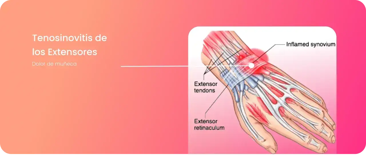 Ilustraci&oacute;n de la tendinitis en la mano, mostrando tendones extensores inflamados y dolor de mu&ntilde;eca.