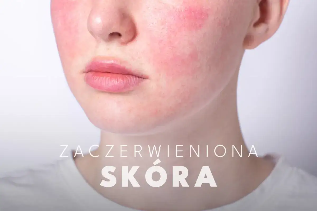 Zaczerwieniona skóra z widocznymi pajączkami naczyniowymi na policzkach.
