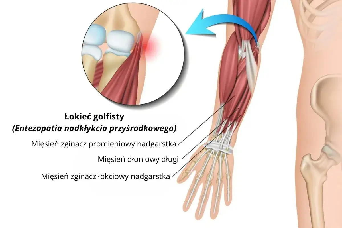 Ból łokcia po wewnętrznej stronie, czyli łokieć golfisty, to zapalenie przyczepów mięśni zginaczy nadgarstka.