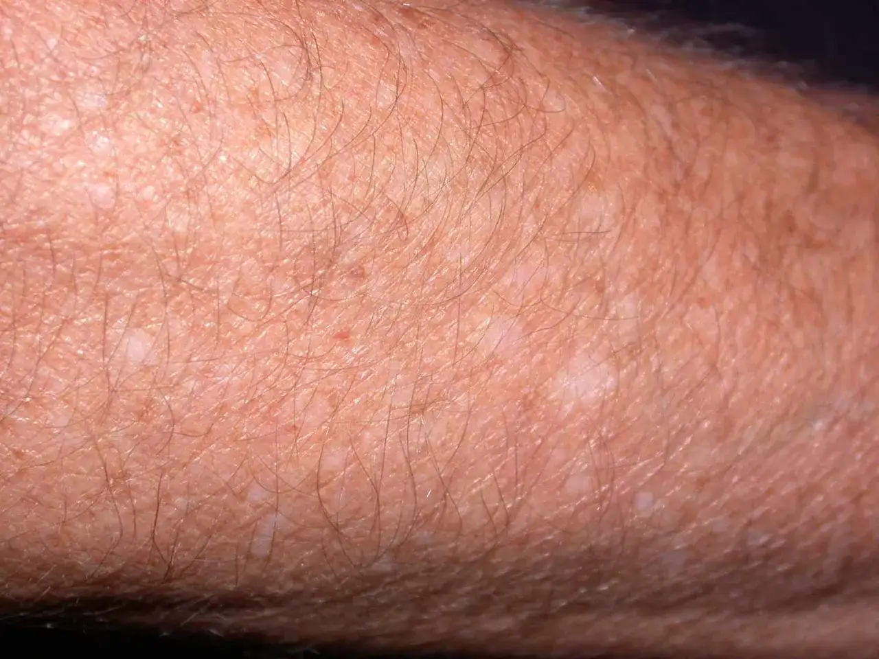 Gros plan sur une peau bronz&eacute;e par le soleil, pr&eacute;sentant des taches blanches, signes d'une exposition prolong&eacute;e.