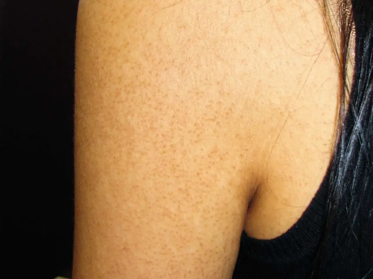 Primer plano de un brazo con piel de gallina, mostrando peque&ntilde;os puntos y vellos finos.