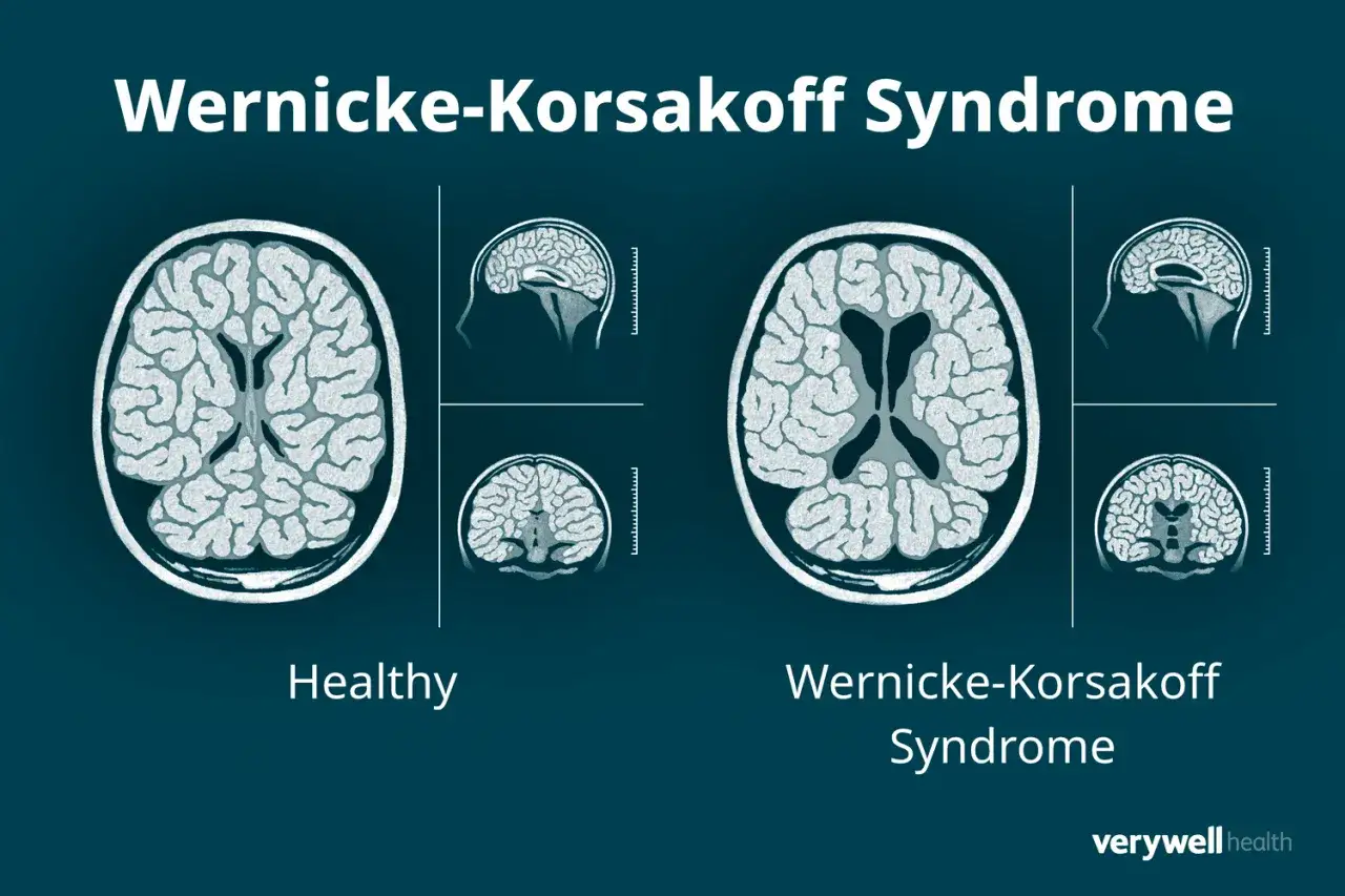 Por&oacute;wnanie m&oacute;zg&oacute;w: zdrowy vs. zesp&oacute;ł Wernickego-Korsakowa. Niedob&oacute;r witaminy B1 powoduje objawy neurologiczne, widoczne jako zanik m&oacute;zgu.