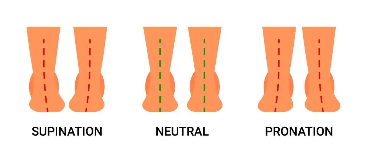 Comparaison des appuis du pied : supination, neutre et pronation. Le pied en pronation montre un affaissement de la vo&ucirc;te plantaire.