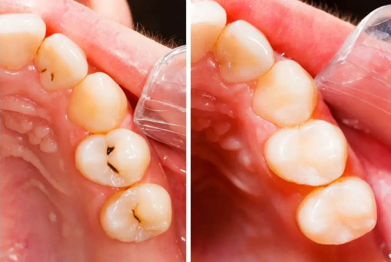 Przed i po leczeniu zębów. Czy próchnica jest zaraźliwa? Zobacz, jak wyglądały zęby z ubytkami, a jak po wizycie u dentysty.