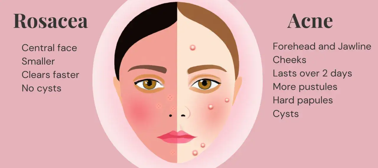 Illustration som visar skillnad mellan rosacea utslag och akne. Rosacea syns i ansiktets mitt, är mindre och läker snabbare.