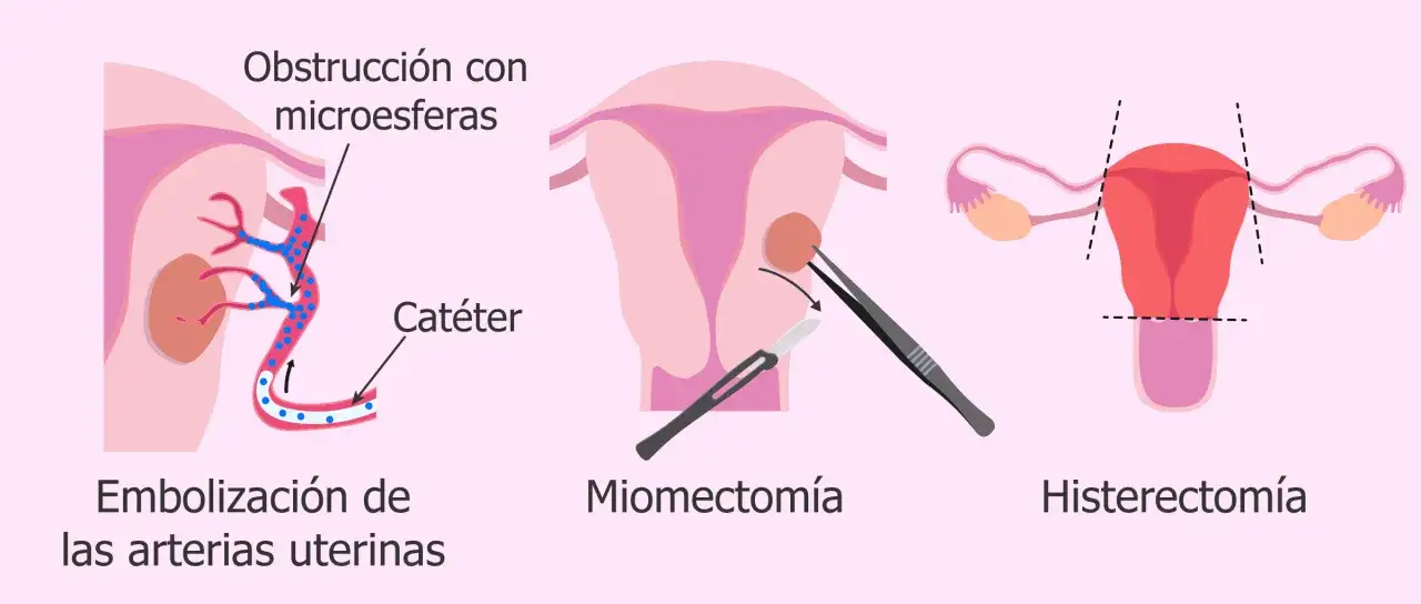 Ilustraci&oacute;n de tratamientos para el mioma uterino: embolizaci&oacute;n, miomectom&iacute;a y<bos> hysterectom&iacute;a.