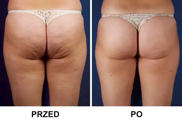Porównanie zabiegów na cellulit, endermologia przed i po, fala uderzeniowa cellulit