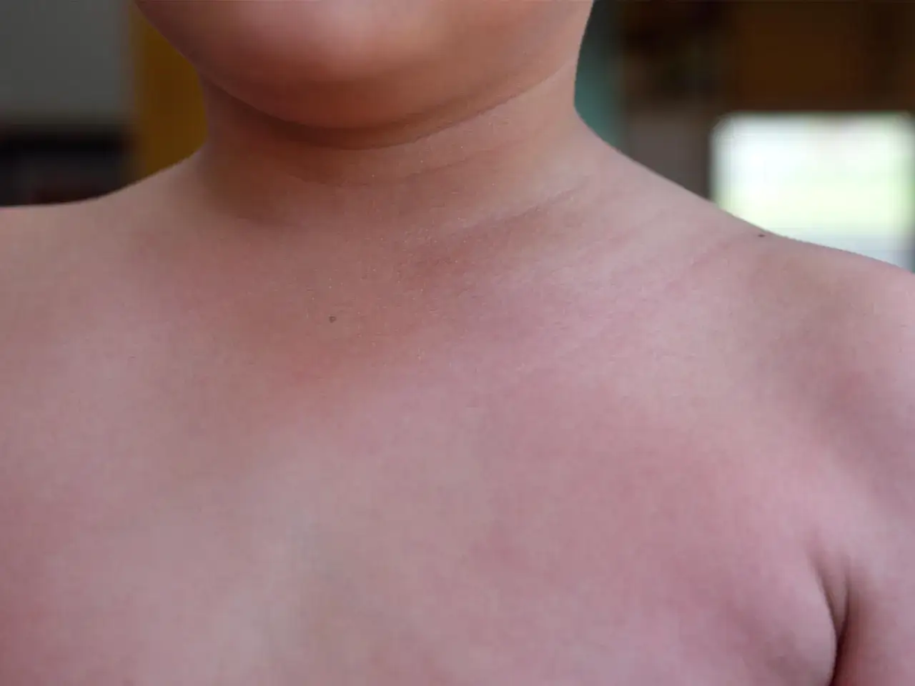 Pelle arrossata con piccoli puntini scarlattina inizio, visibili sul collo e sulle spalle di un bambino.