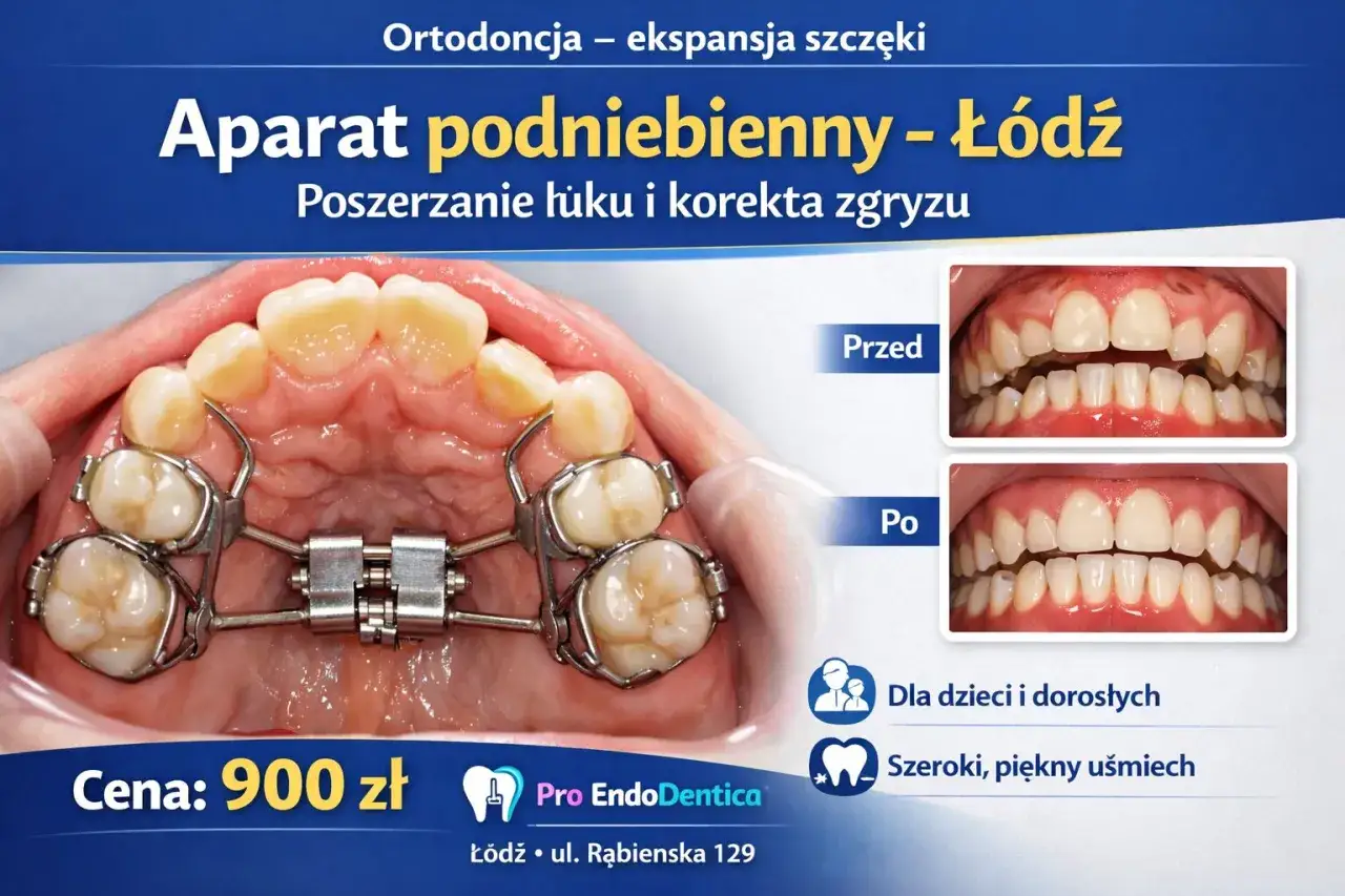 Aparat ortodontyczny na podniebienie, który poszerza łuk i koryguje zgryz. Efekty przed i po.