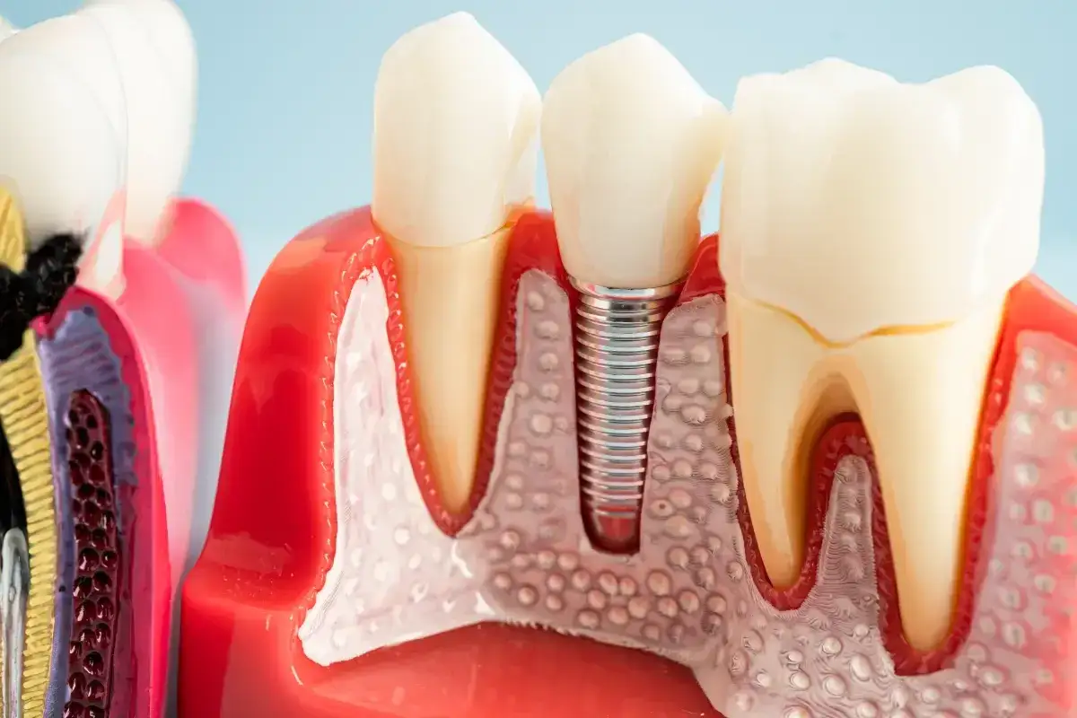 Model szczęki z implantem zęba. Widać metalowy implant wkręcony w kość, otoczony przez tkankę kostną i dziąsło.