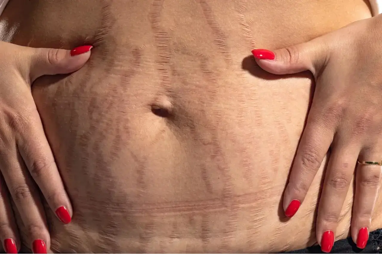 Gros plan sur la peau femme enceinte, marquée par des vergetures, avec des mains aux ongles rouges la caressant.