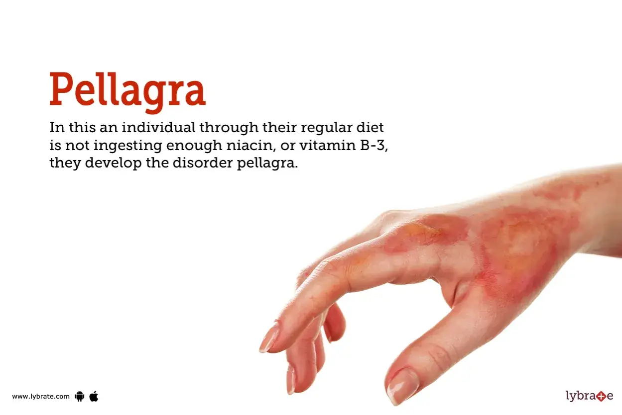 Mano con eruzione cutanea rossa e squamosa, sintomo della pellagra, malattia da carenza di niacina.