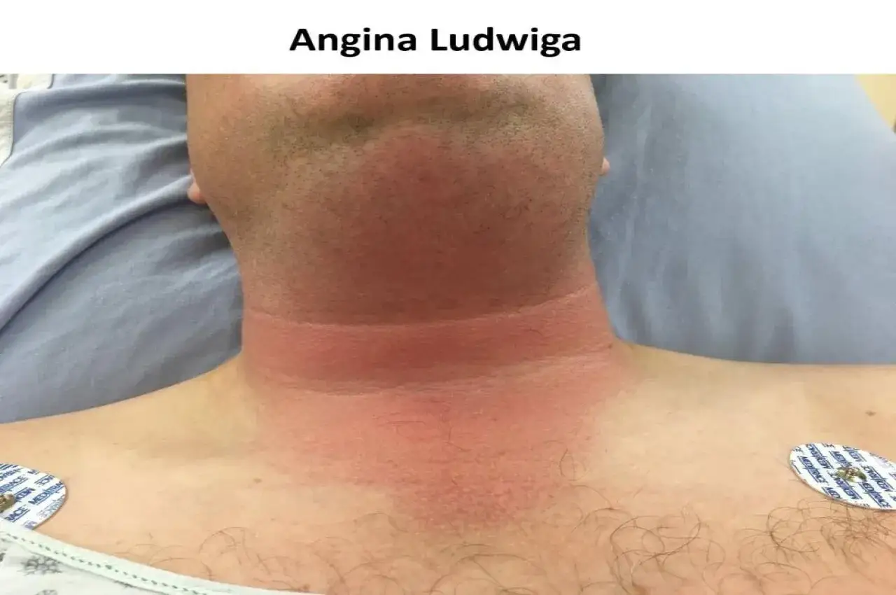 Obrzęk i zaczerwienienie szyi, objawy wskazujące na anginę Ludwiga. Pacjent w szpitalu.