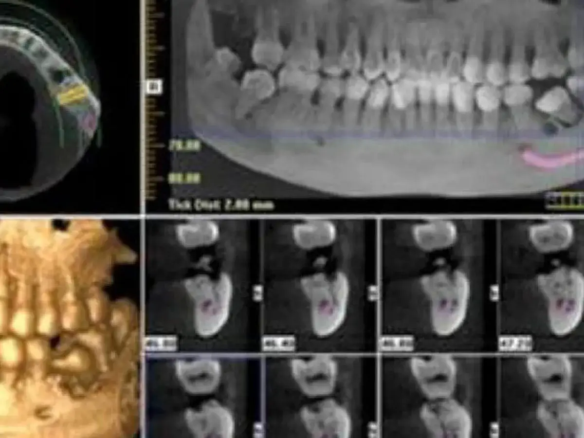 Radiografía dental muestra una muela del juicio impactada, inclinada hacia la mejilla, con varias vistas de corte transversal.