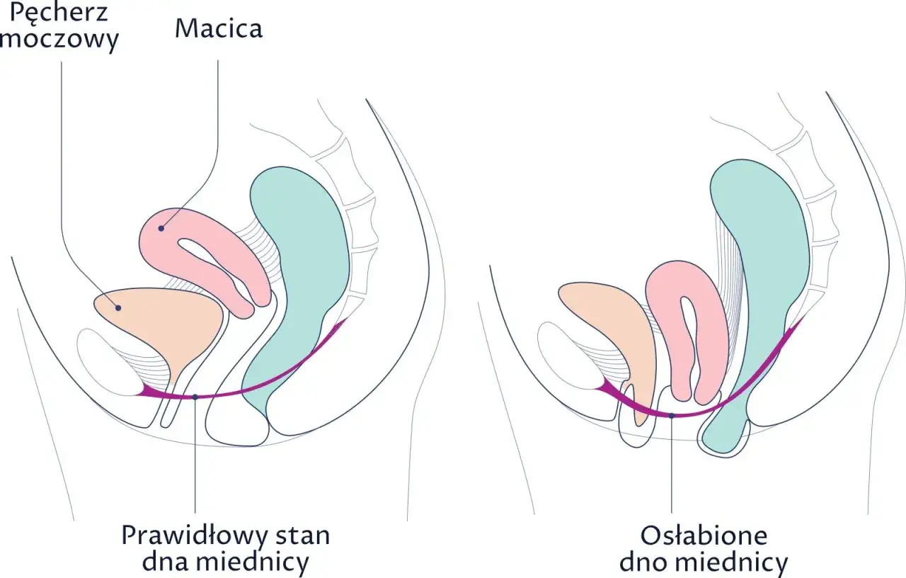 Porównanie prawidłowego i osłabionego dna miednicy z widoczną macicą, pęcherzem i odbytnicą.