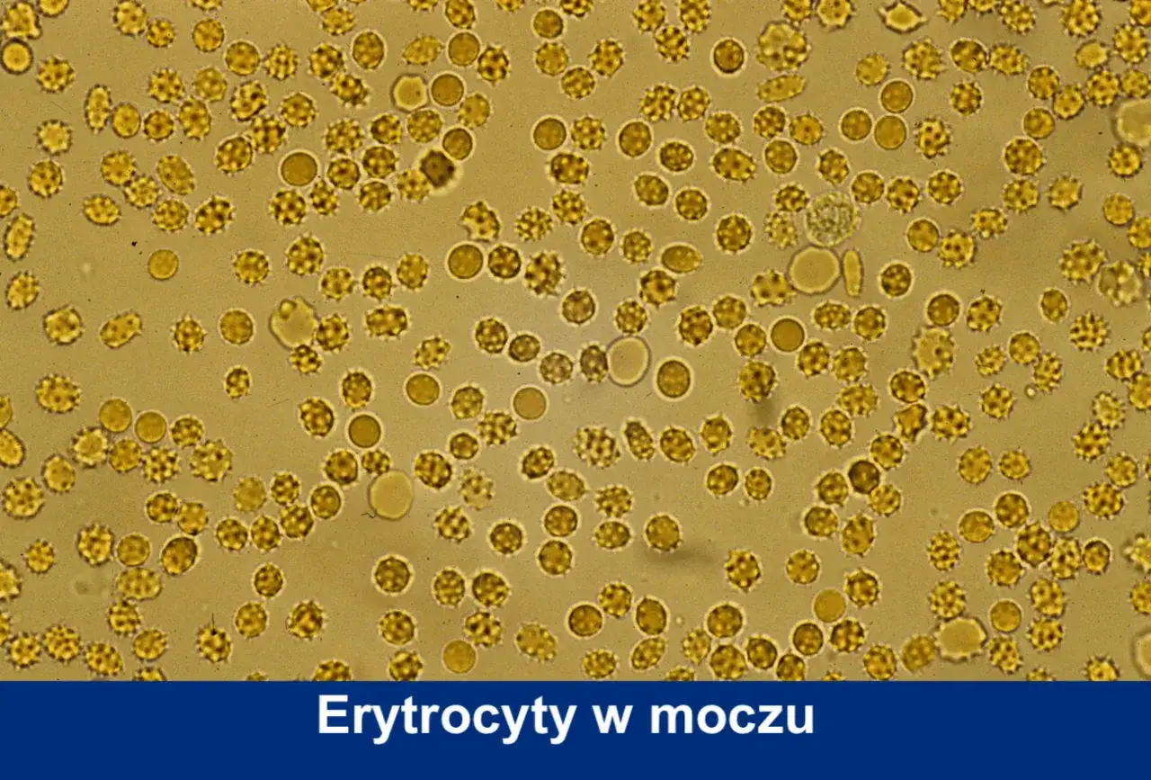 Mikroskopowy obraz erytrocytów w moczu. Widać liczne, okrągłe komórki, niektóre o postrzępionych brzegach, świadczące o ich obecności w próbce.