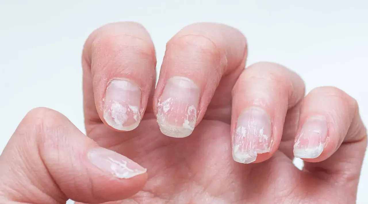 Nagelverletzung Manik&uuml;re