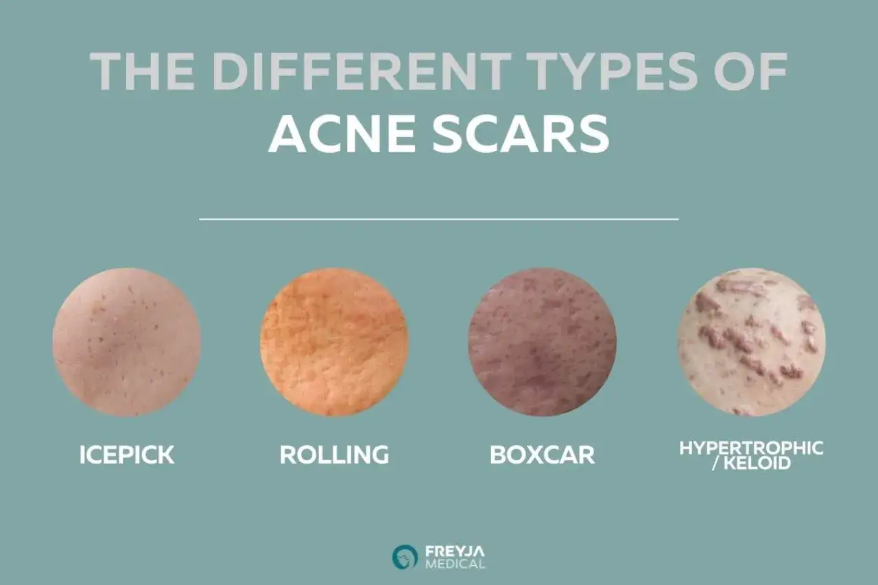 Tipi di cicatrici da acne: icepick, rolling, boxcar e ipertrofiche/cheloidi. Scopri come eliminare le macchie post brufoli.