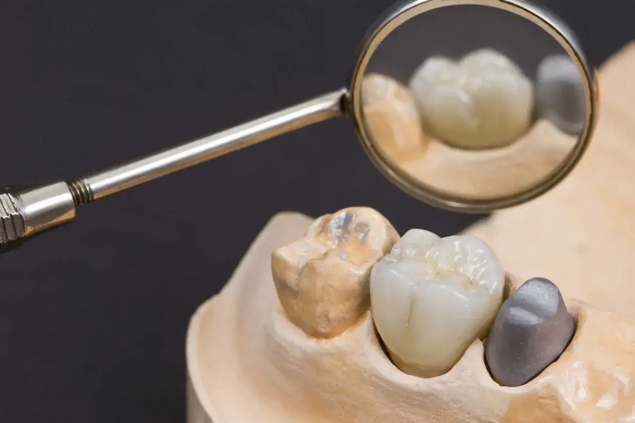 Model szczęki z zębami, w tym korony protetyczne i metalowy implant. W odbiciu lusterka dentystycznego widać fragmenty uzupełnień, które mogą być wykonane z materiałów przypominających złote zęby.