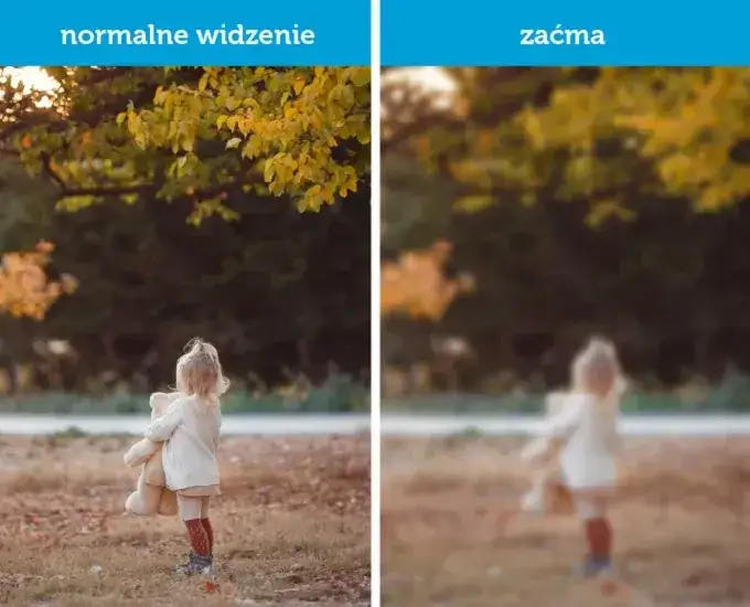 zaćma jak widzi osoba z zaćmą porównanie