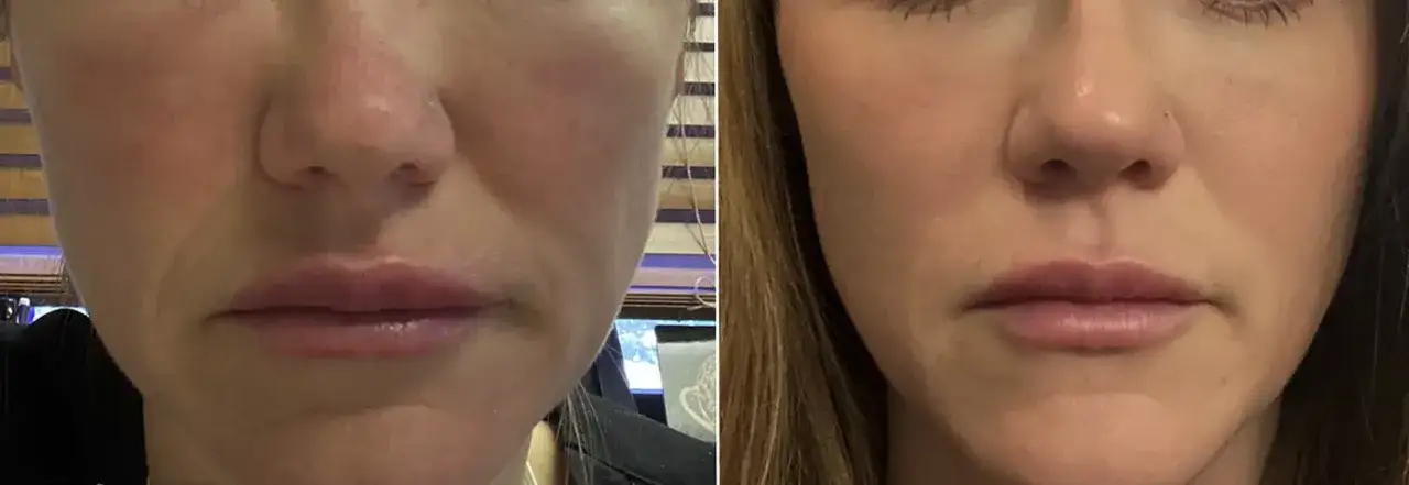 Före- och efterbilder på läppar som visar resultat efter fillers. Nu kan hon flyga efter fillers med fylligare läppar.
