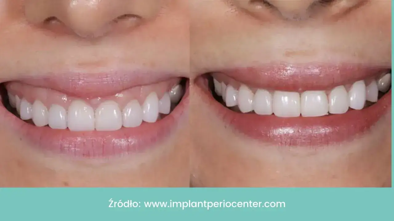 Uśmiech przed i po zabiegu, który zredukował tzw. gummy smile. Botoks może pomóc w osiągnięciu idealnego uśmiechu.