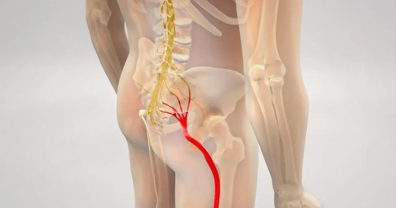 Anatomical illustration showing the sciatic nerve, highlighted in red, indicating pain or irritation associated with rwa kulszowa.