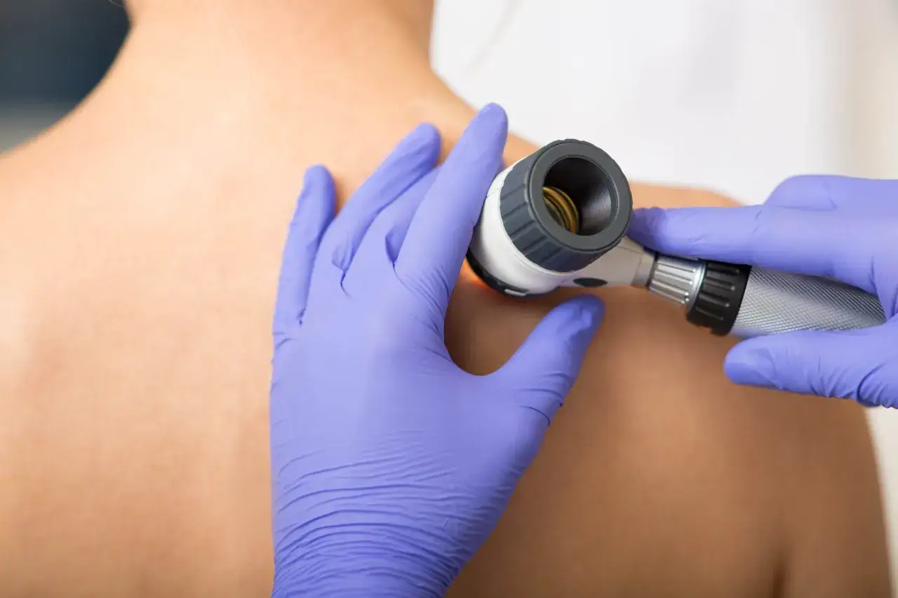 Dermatolog w fioletowych rękawiczkach bada pieprzyk na plecach pacjenta za pomocą dermatoskopu. To ważna wizyta u dermatologa.