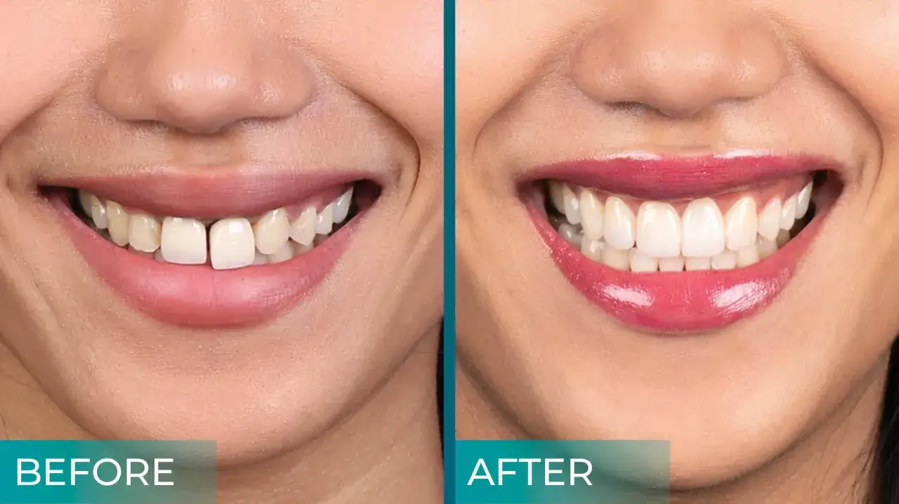 Prima e dopo: sorriso con diastema e poi con denti in zirconio perfetti. Valutare i denti in zirconio pro e contro per un sorriso ideale.
