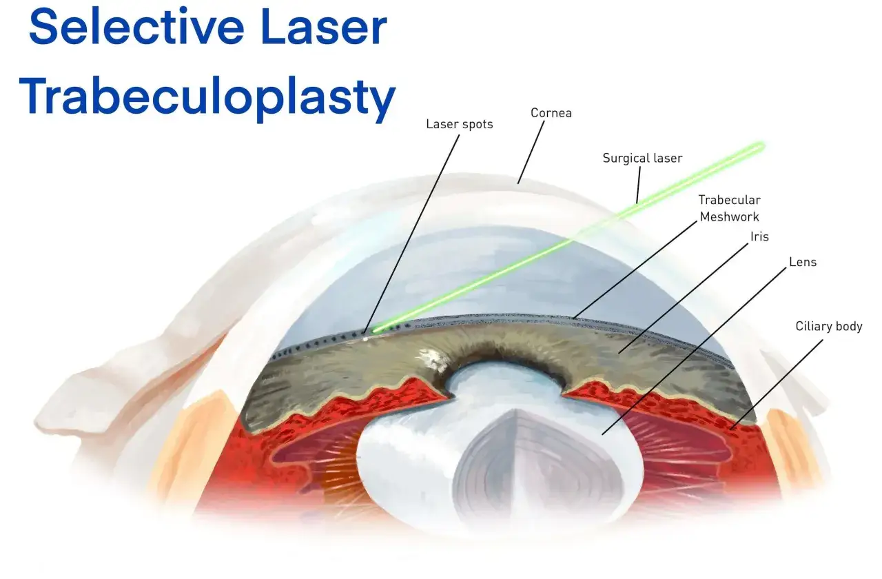 Illustrazione anatomica dell'occhio che mostra la trabeculoplastica laser selettiva. Valutare i rischi di questa procedura.