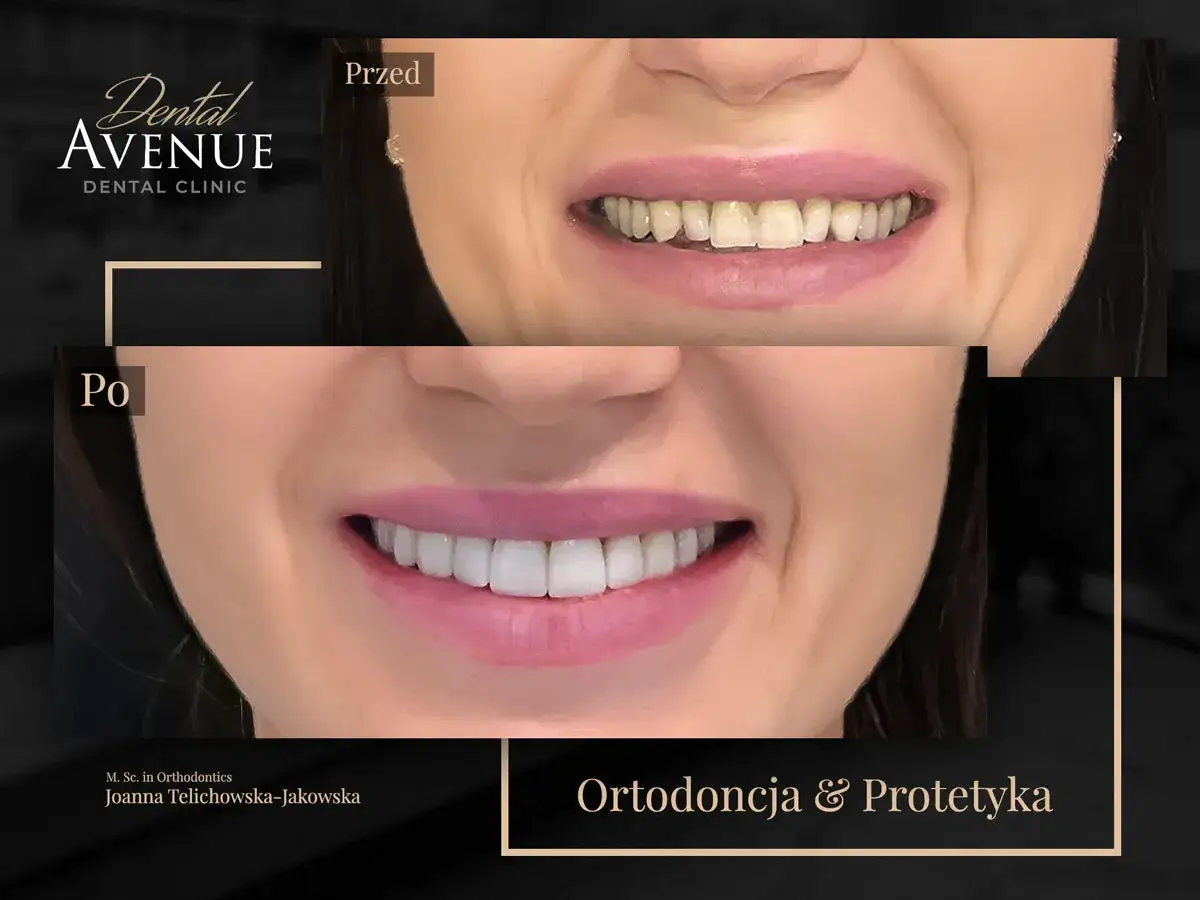 Przed i po: metamorfoza uśmiechu dzięki licówkom na krzywe zęby. Piękny, prosty uśmiech w Dental Avenue.