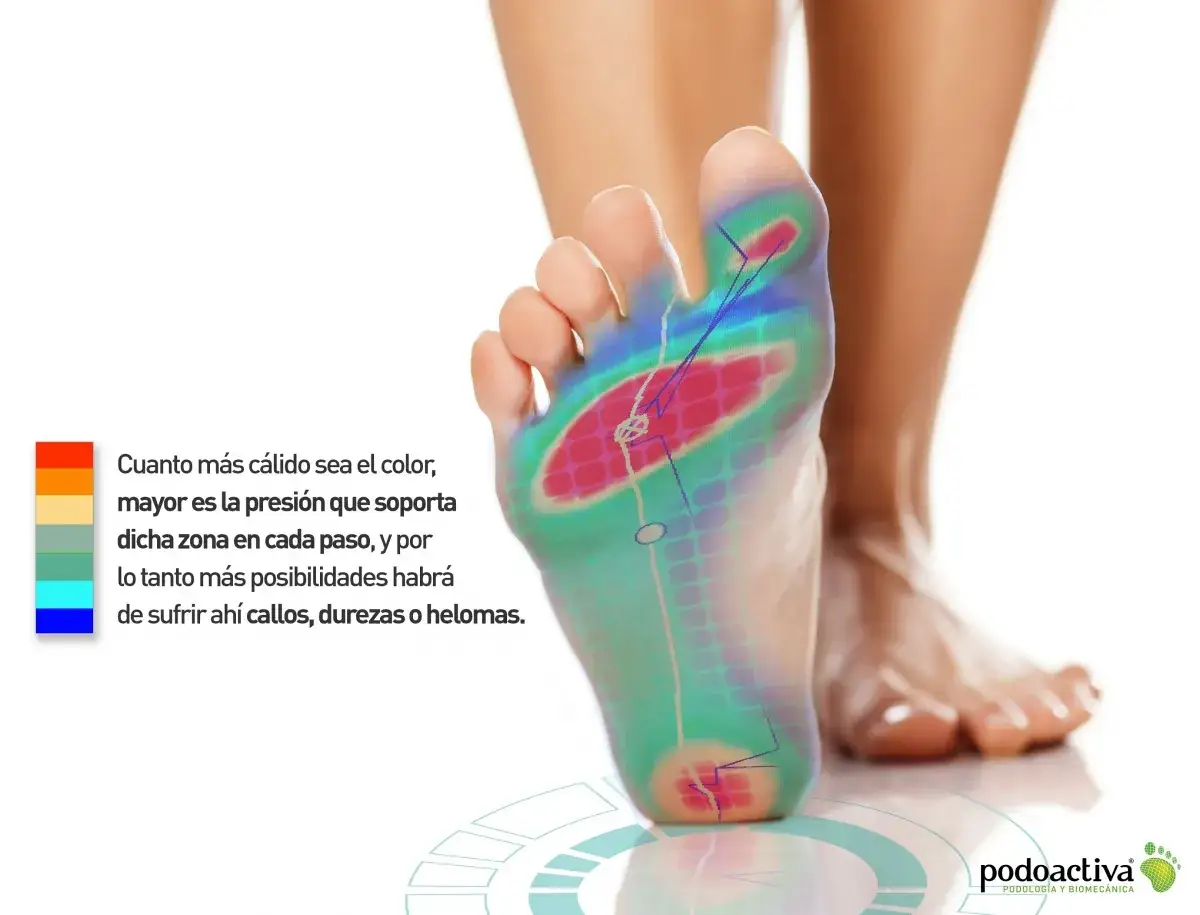 Mapa de presión plantar que muestra zonas de alta presión (rojo) donde pueden aparecer callos en los pies.