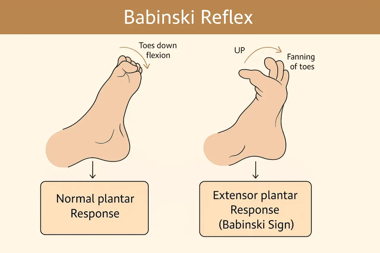 Il riflesso di Babinski: un piede mostra la normale risposta plantare con le dita flesse, l'altro il segno di Babinski con le dita che si aprono a ventaglio.