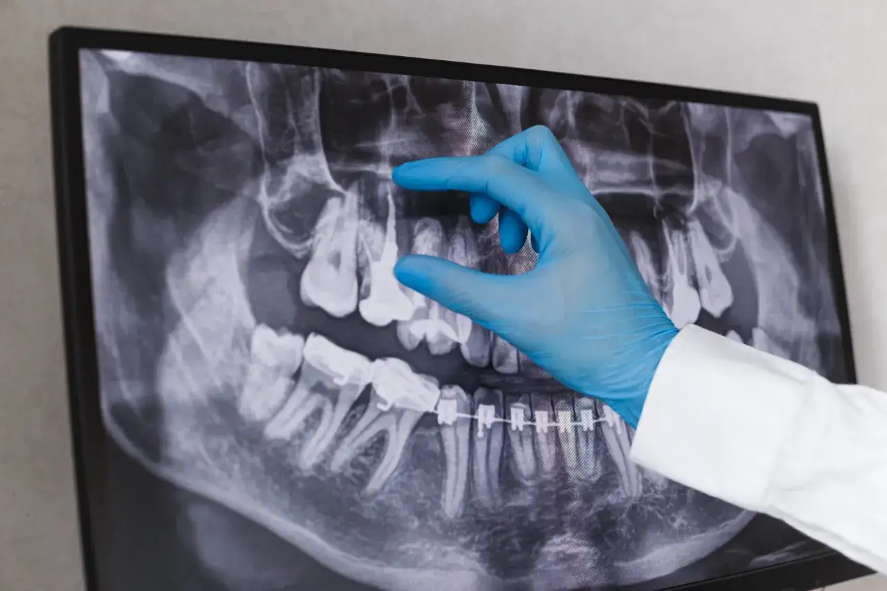 Dentysta w niebieskiej rękawiczce wskazuje na prześwietlenie zęba, gdzie widoczna jest próchnica.