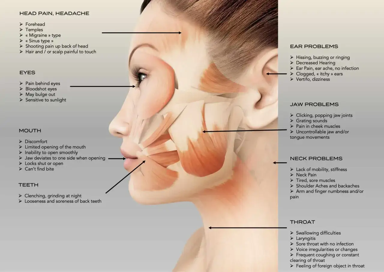 Anatomia twarzy z zaznaczonymi mięśniami i objawami bruksizmu: bóle głowy, uszu, gardła, szczęki, zębów.