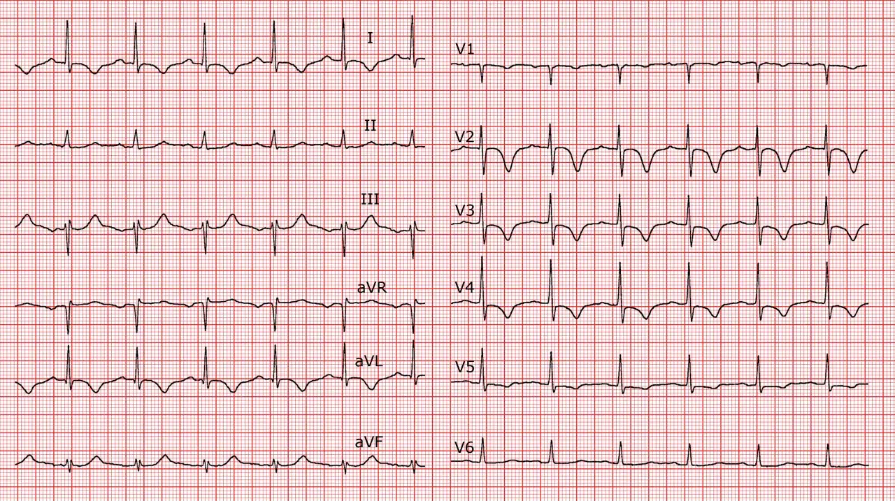 EKG-Aufzeichnung mit ST-Hebungen in mehreren Ableitungen, die auf einen akuten Herzinfarkt hindeuten.