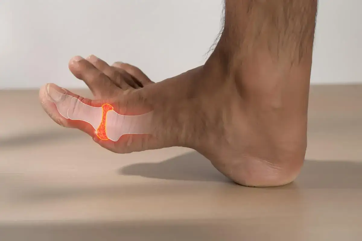 Fuß mit hervorgehobener Knochenstruktur des Großzehengrundgelenks, die auf Hallux rigidus hinweist.