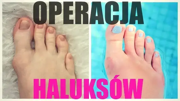 Kobieta pływająca po operacji haluksa