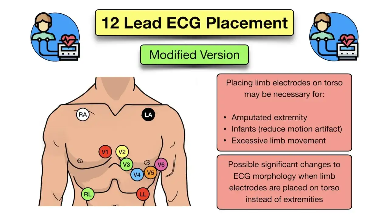Placement modifi&eacute; d'un &eacute;lectrode ECG sur le torse pour des cas sp&eacute;cifiques comme les amputations ou les nourrissons.