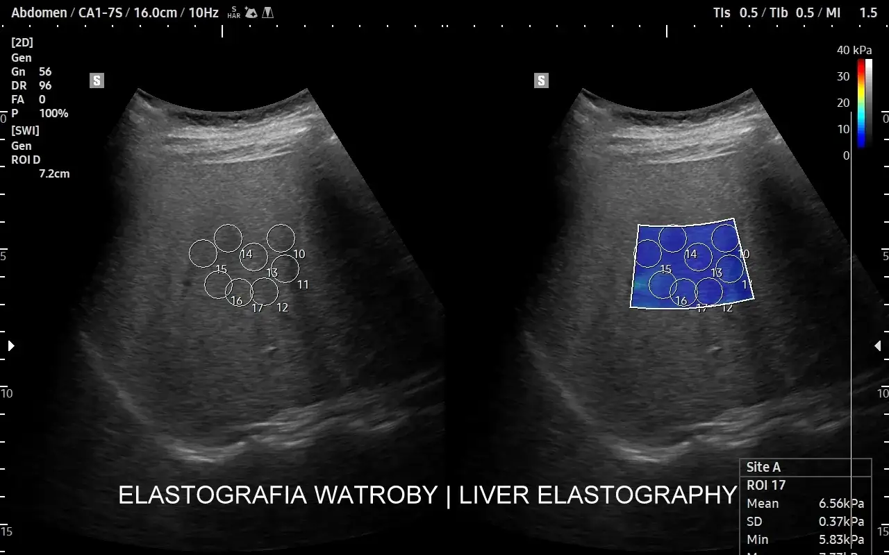 Badanie elastograficzne wątroby, kluczowe dla hepatologa, pokazuje obraz USG z zaznaczonymi obszarami pomiaru sztywności tkanki.