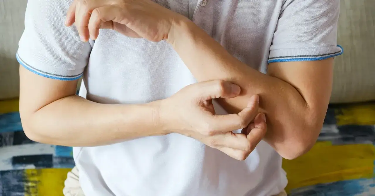 Mężczyzna drapie się po przedramieniu, co może być jednym z objawów hiv u mężczyzn.