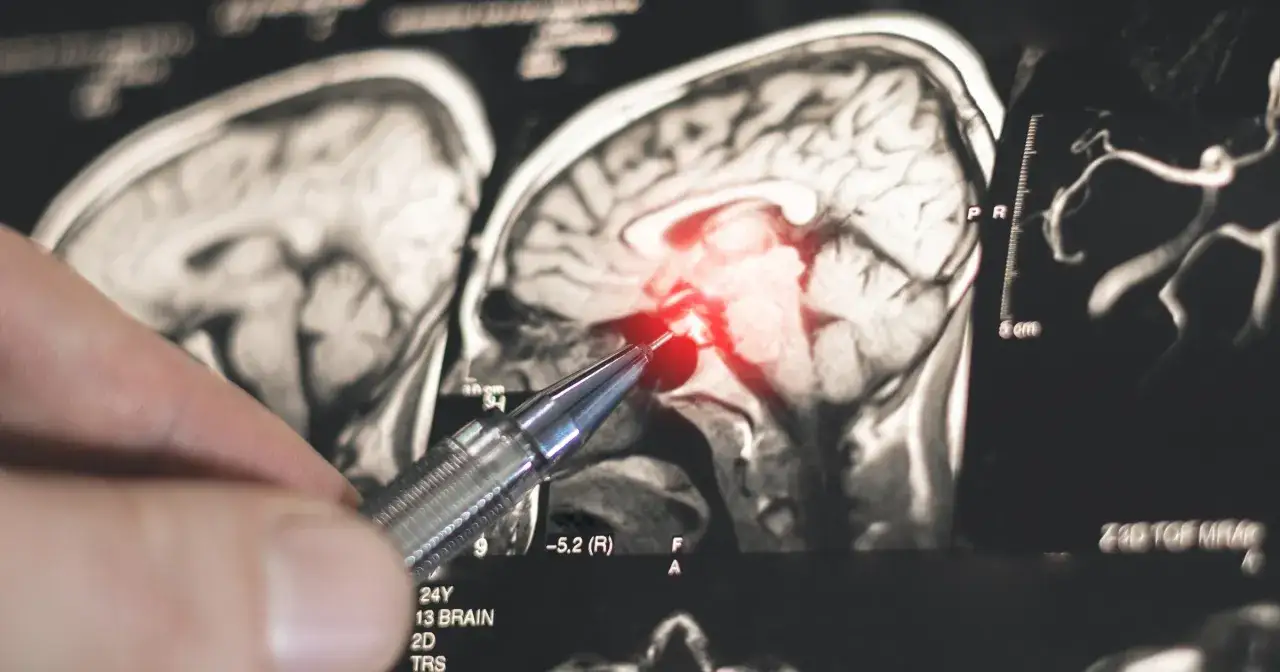 Dłoń z długopisem wskazuje na rezonans magnetyczny mózgu, gdzie czerwony obszar podkreśla problem. To obraz, który pomaga zrozumieć, neurologia co to.
