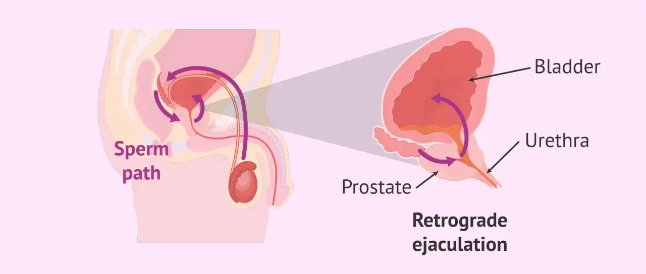 Illustrazione anatomica del percorso dello sperma e dell'eiaculazione retrograda, che solleva curiosità quando un uomo non viene.