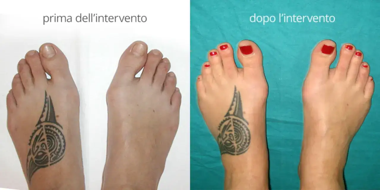 Piedi prima e dopo intervento per alluce valgo. Il piede sinistro mostra un inizio di alluce valgo, il destro è stato corretto.