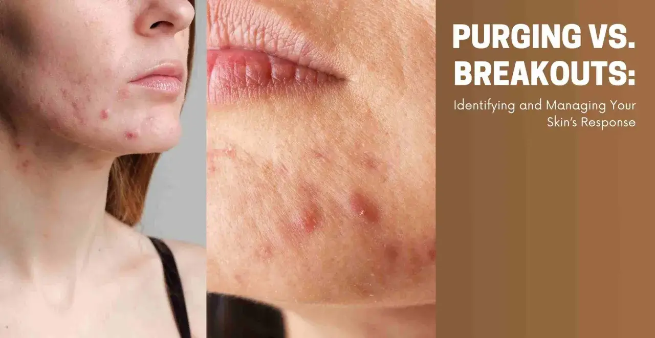 Close-up of a face with acne breakouts, showing red pimples and inflammation. Text overlay reads 