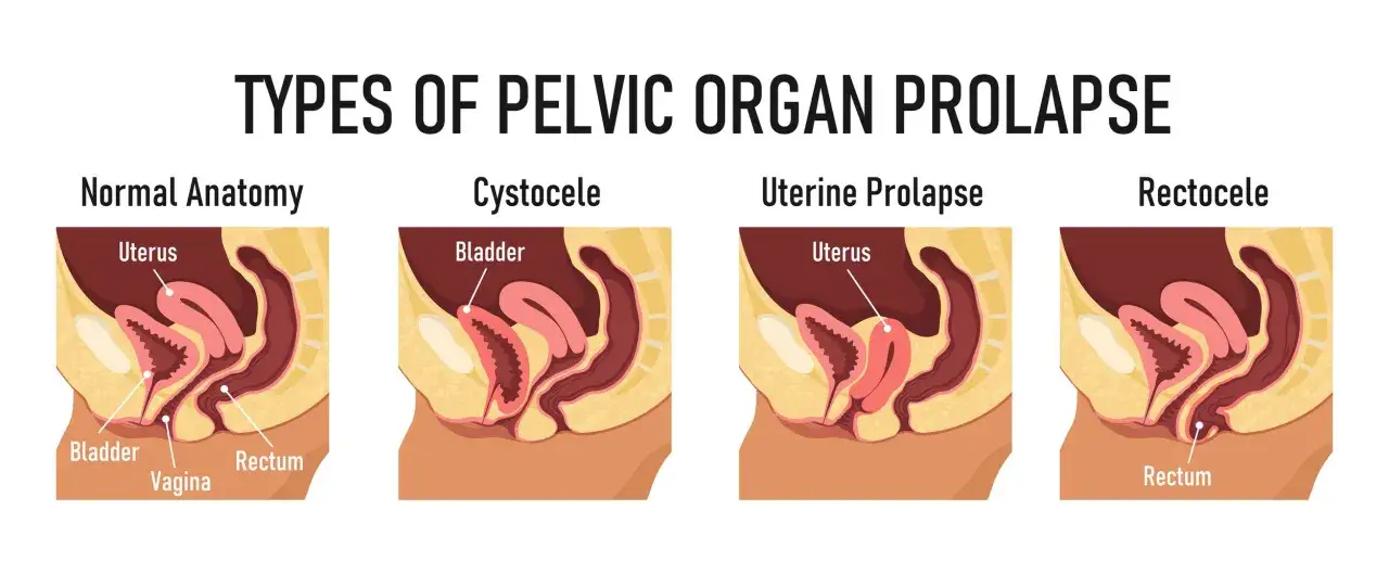 Comparaison anatomique : utérus, vessie, vagin, rectum. Illustrations montrant le prolapsus des organes pelviens, une cause de fatigue.