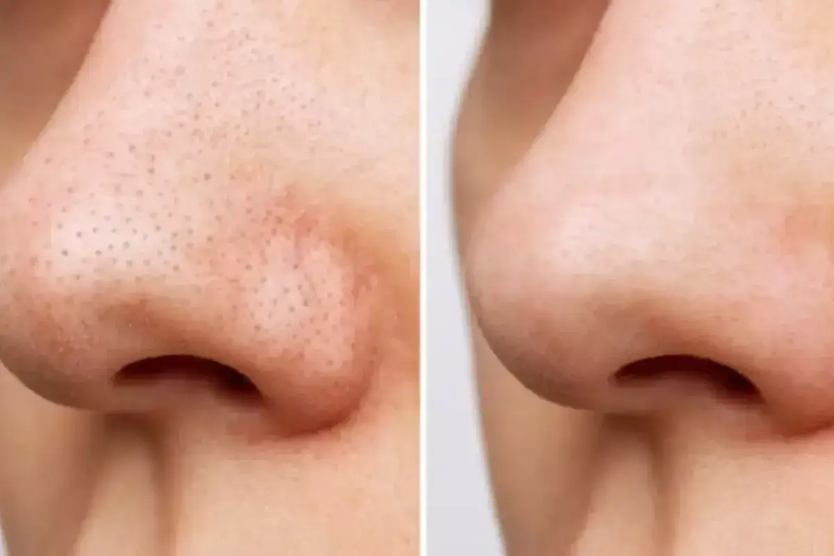 Comparaison avant/apr&egrave;s : un nez avec des pores dilat&eacute;s et des points noirs, puis un nez &agrave; la peau lisse et nette. Adieu le nez qui pele !