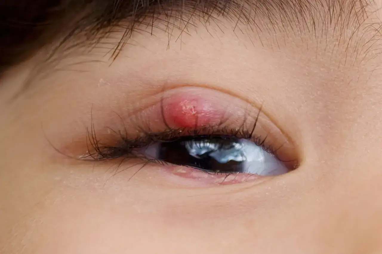 Ein roter, geschwollener Gerstenkorn am Augenlid. Er sieht entz&uuml;ndet aus und k&ouml;nnte ansteckend sein.